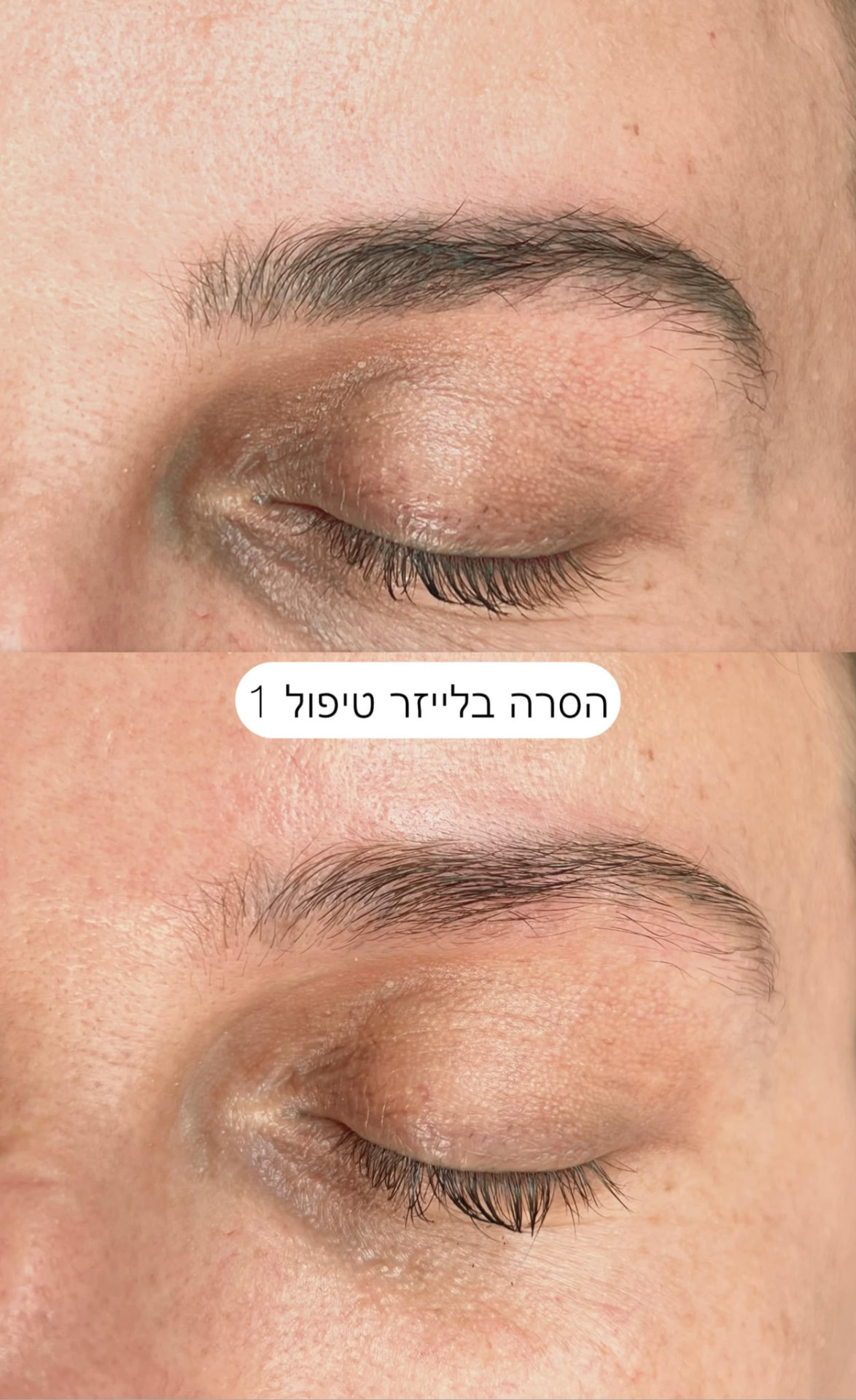 הסרה בלייזר - טיפול 1
