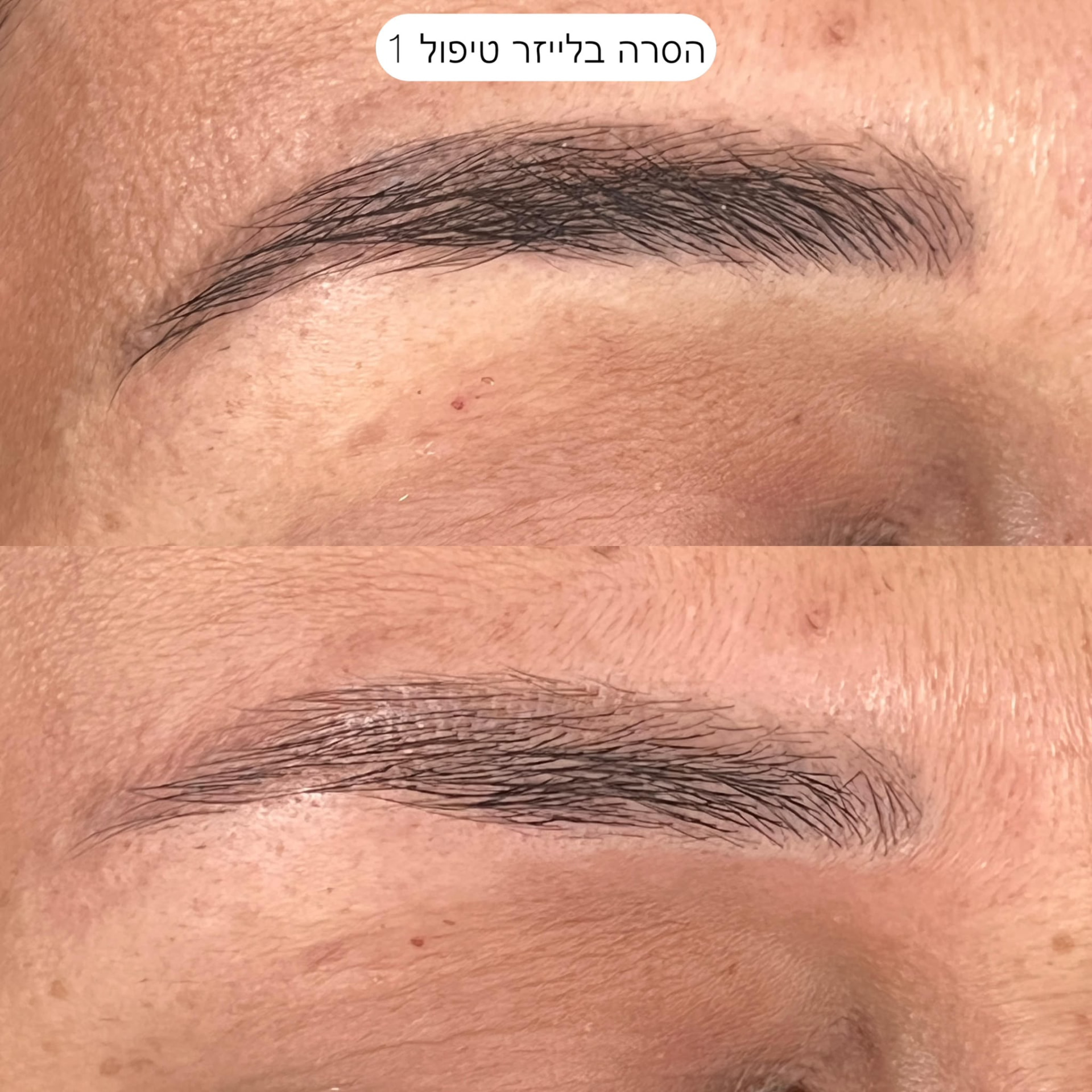הסרה בלייזר - טיפול 1
